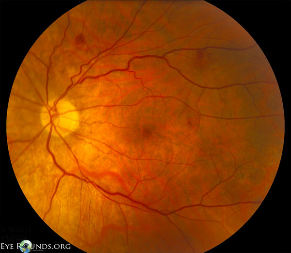  fundus after chemotherapy, and her follow-up fundus photos are shown below 4