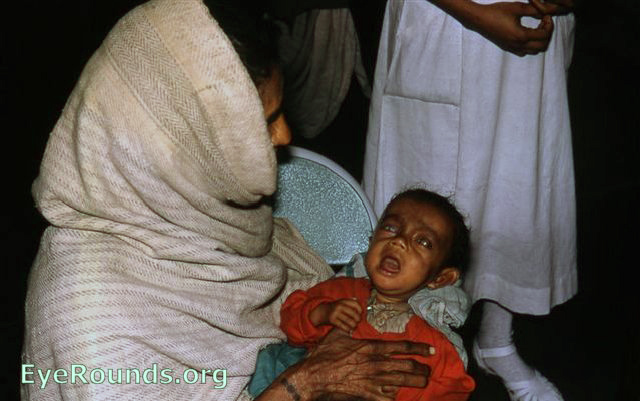 Marasmic 2 yr old blind child due to xerophthalmia caused by vitamin A deficiency