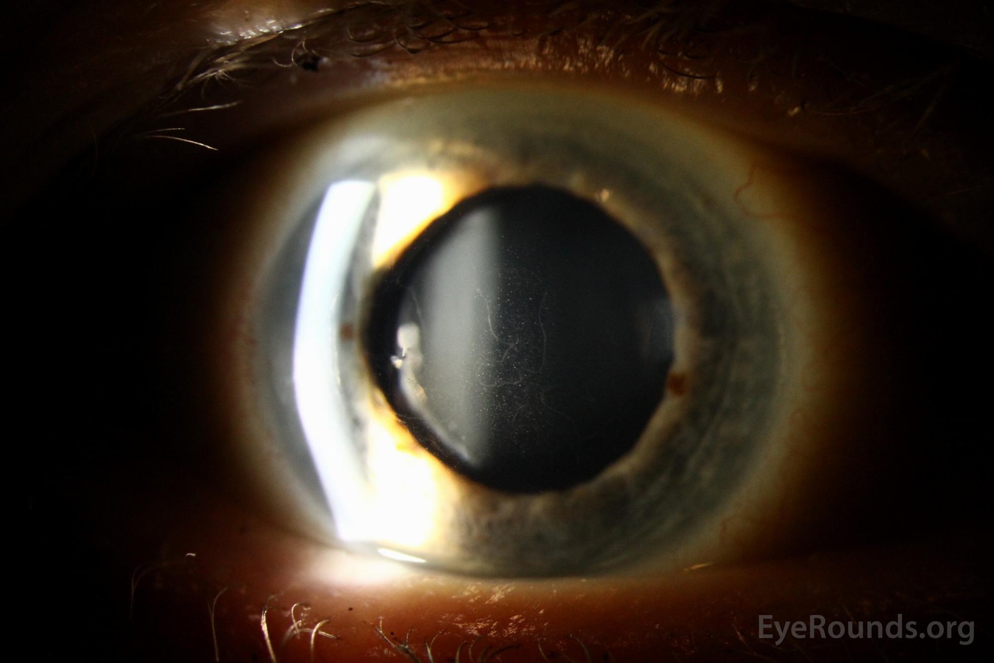 meesmann-epithelial-corneal-dystrophy