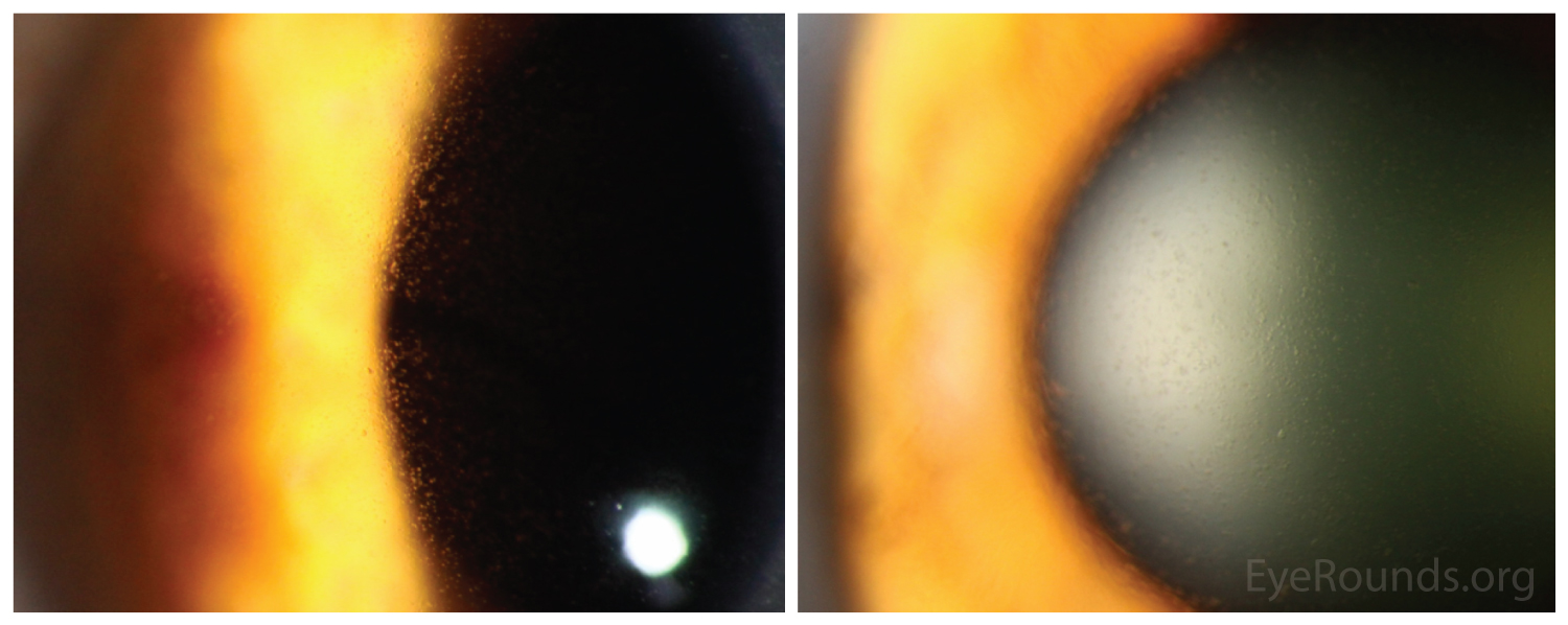 Meesmann Epithelial Corneal Dystrophy