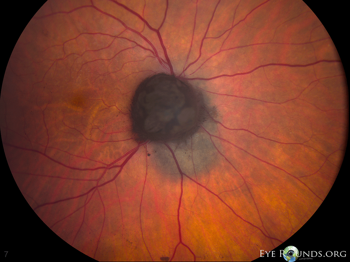  deeply pigmented benign tumor often appearing over the optic disc