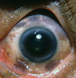 Malignant Melanoma of Eye: Causes, Symptoms & Diagnosis