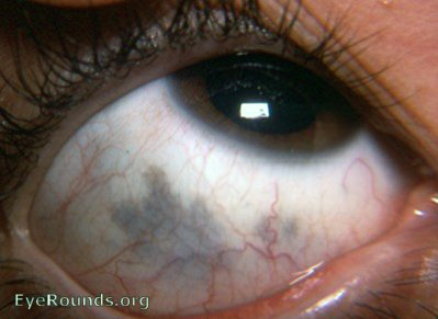 Pigmented Conjunctival Cancers (primary acquired melanosis)