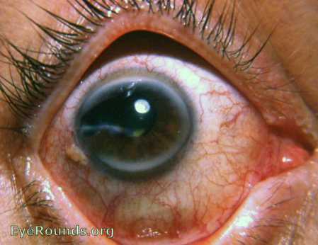scissors perforation of cornea, adherent leucoma, 