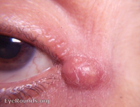 sebaceous cyst at inner canthus OD