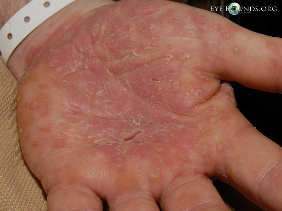 Causes of Palm rash - RightDiagnosis.com