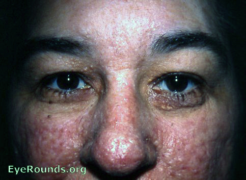 Pringle's Disease ( adenoma sebaceum ) in patient with tuberose ( tuberous ) sclerosis ( Bourneville's Disease )