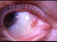 papilloma eye