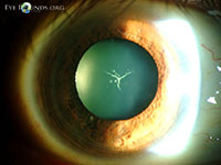 Y Suture Cataract