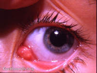 Lacrimal Caruncle Inflammation