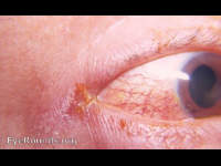 angular conjunctivitis