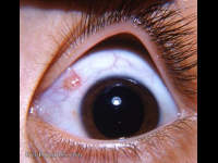 Conjunctival Cyst Causes