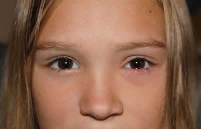 Orbital Cellulitis in a Child. EyeRounds.org - Ophthalmology - The 