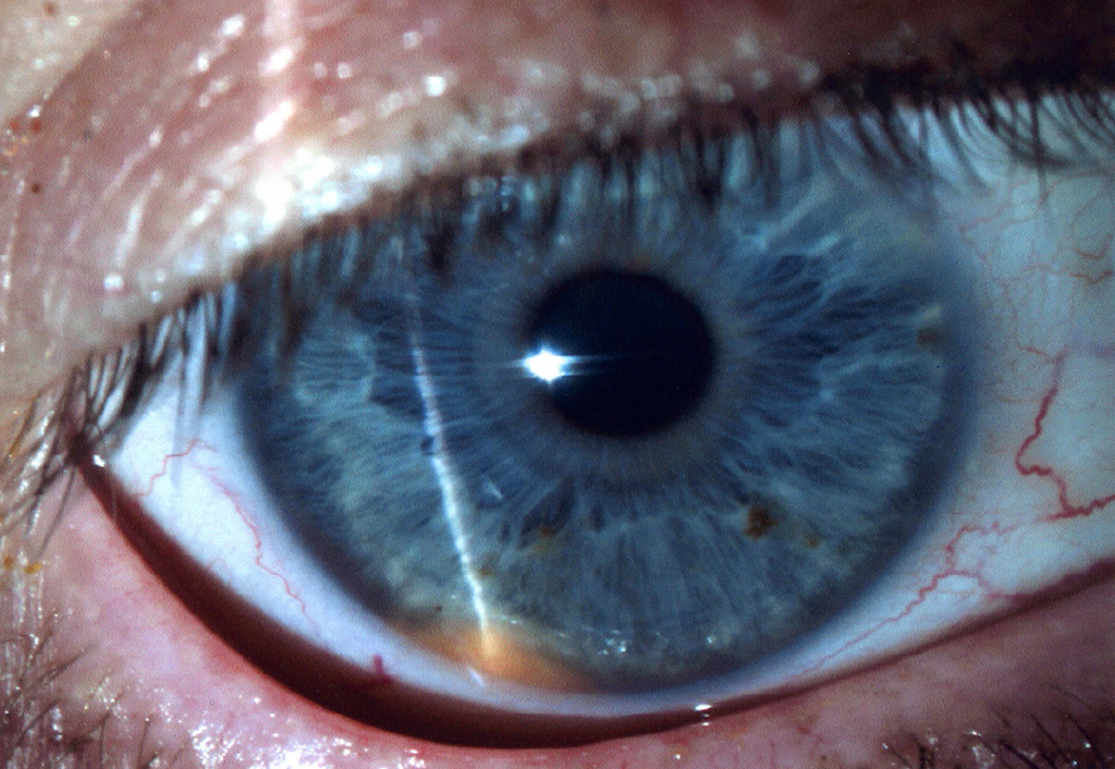 Figure 1 : Small lightly pigmented, slightly elevated lesion at the 