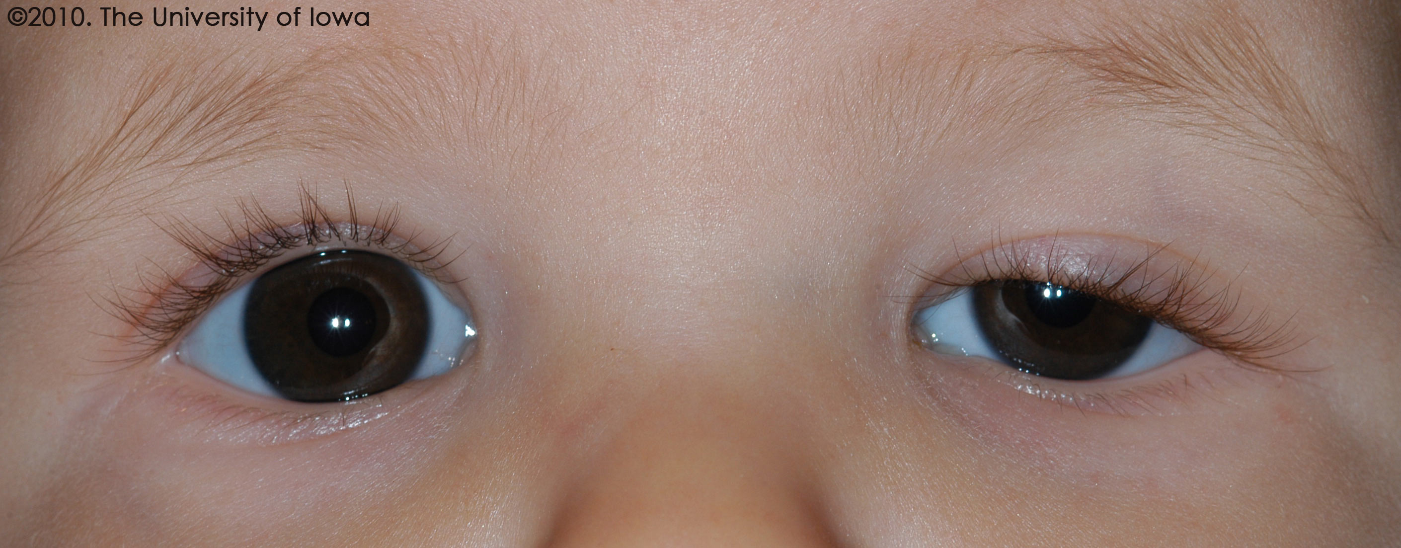 congenital-ptosis-eyerounds-ophthalmology-the-university-of-iowa