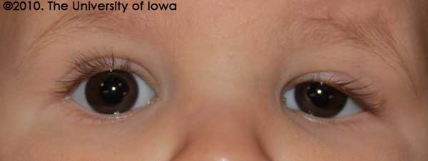   Note that the upper eyelid position has improved and that the eyelid margin is above the visual axis