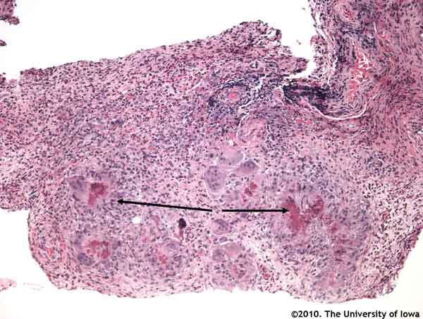 Figure 4: Hematoxylin and eosin stain at 50X magnification of orbital tissue reveals multinucleated giant cells arranged into granulomas (arrows) with necrotic centers (caseating granuloma). 