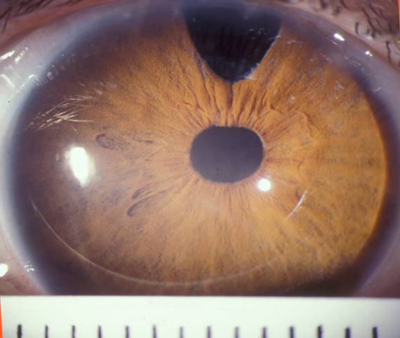 Gross visualization shows cornea white to white measuring >15 mm. 