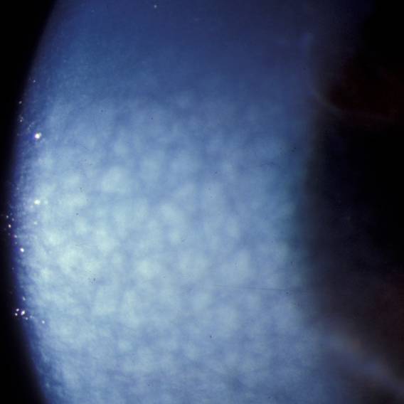 Figure 2. Slit-lamp examination revealing central mosaic dystrophy in a patient with megalocornea.