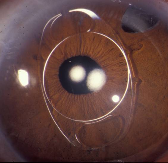 Figure 3. Artisan anterior chamber IOL in a patient with megalocornea.
