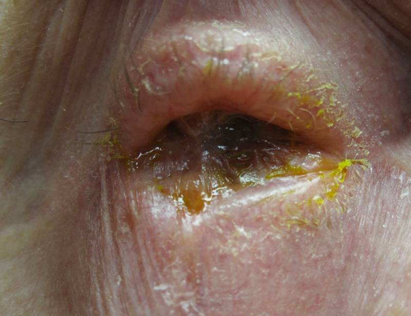 Ocular rosacea - NHS Choices Home Page