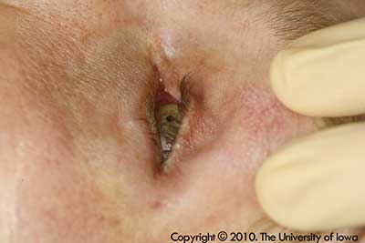 Bilateral enophthalmos with lack of apposition of all four eyelids from the ocular surface