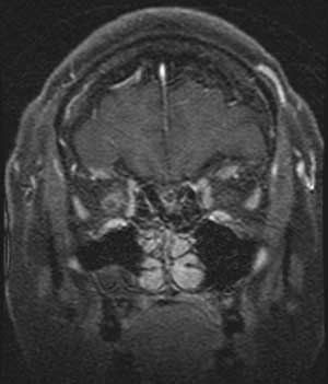 Meningiomas case with photos fig7b-sm.jpg