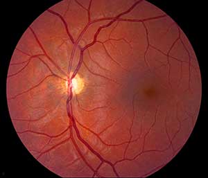 Left fundus, maekedly pale with peripapillary atrophy or a double ring sign