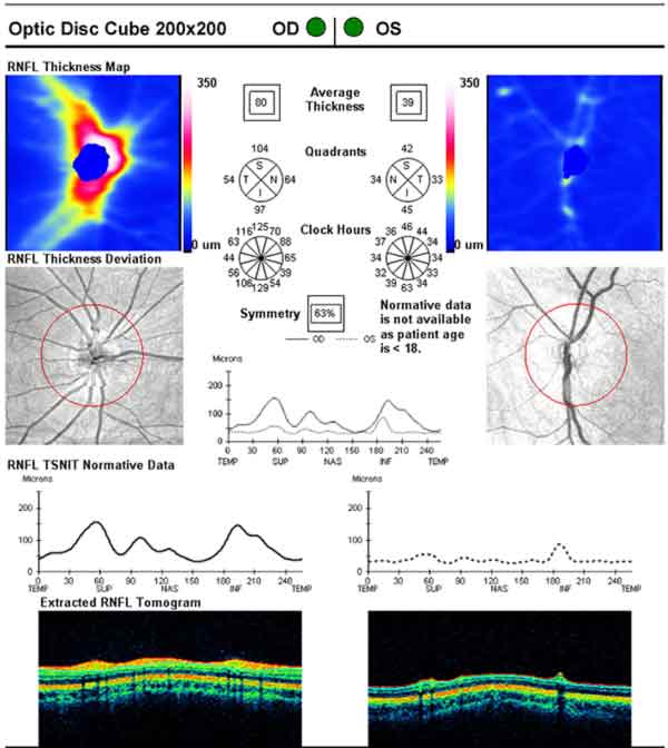 Cirrus OCT of bilateral optic nerves