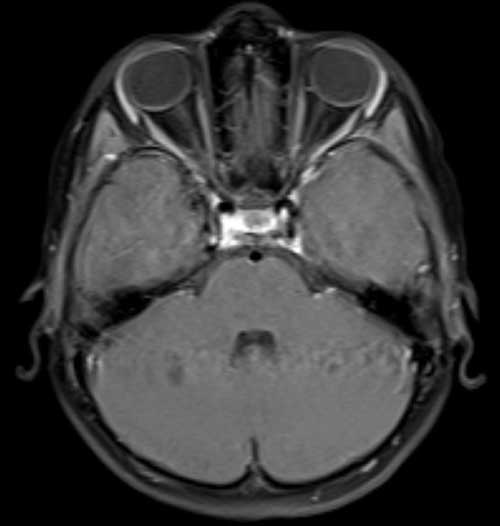 MRI brain axial t1 FS post GAD