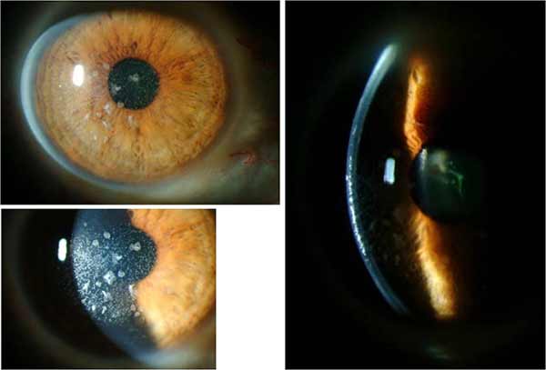 Slit lamp photos of the right eye, following superficial keratectomy and phototherapeutic keratectomy (PTK), but prior to Intralase-enabled superficial anterior lamellar keratoplasty