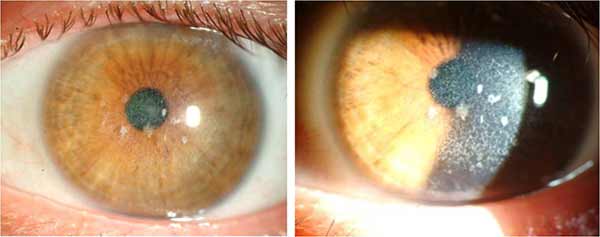 Slit lamp photo of left eye, after superficial keratectomy and PTK (>30 days ago), taken at the time of OD post-operative photo (Figure 5), without significant worsening since initial treatment (click image for higher resolution photo) 