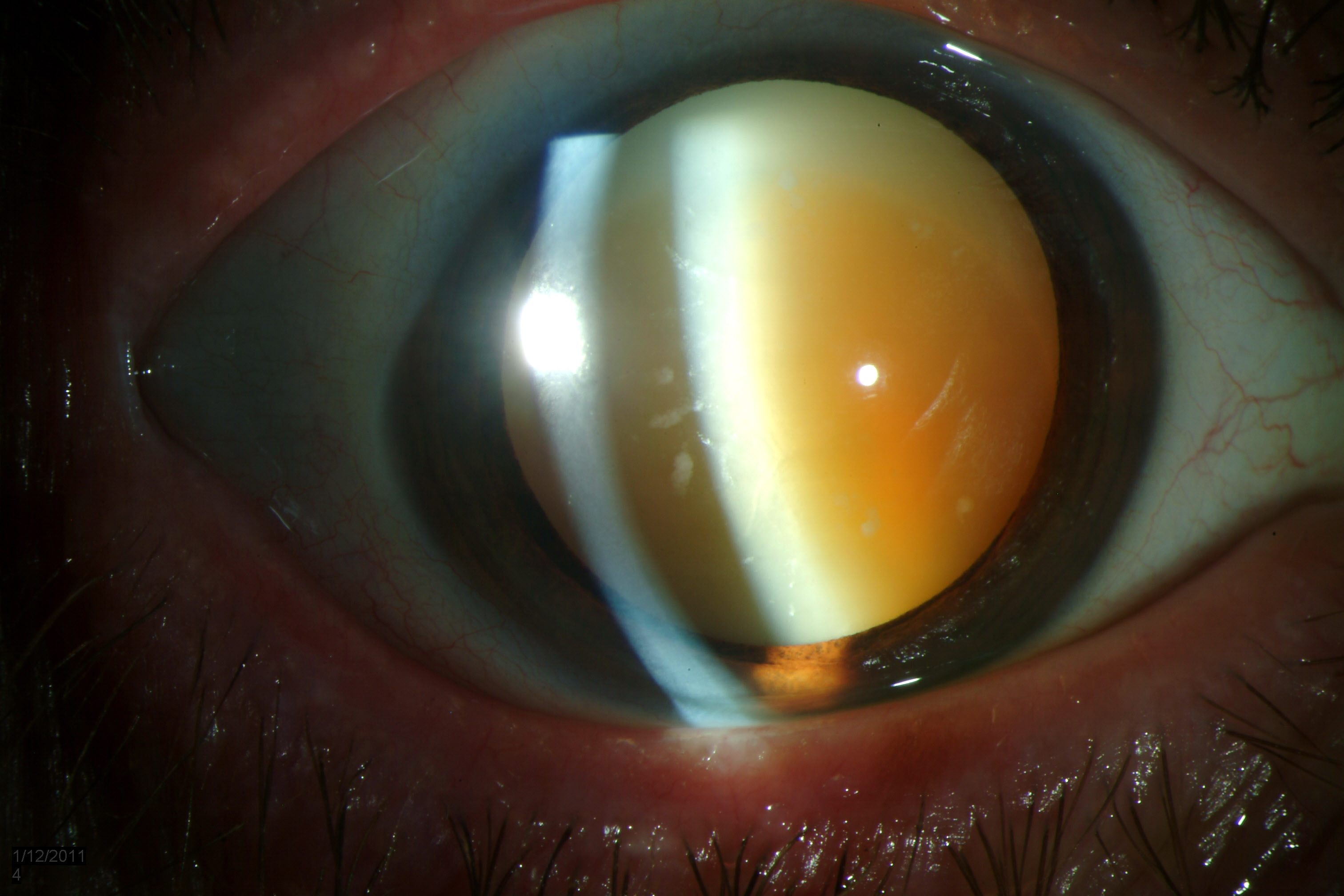 Morgagnian Cataract. EyeRounds.org - Ophthalmology - The University of Iowa