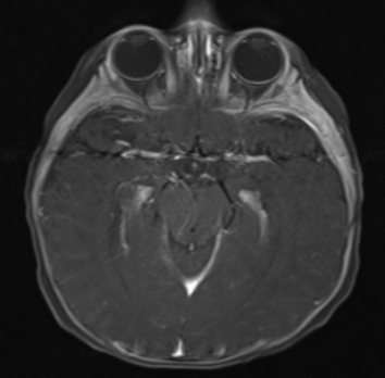 Figure 2b shows bilateral severe optic nerve hypoplasia