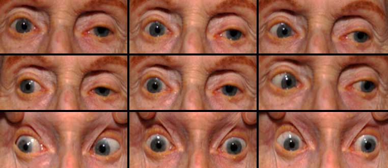 superior gaze palsy