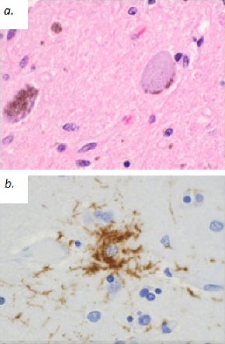 Histology in Supranuclear Palsy