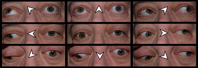 third-nerve-palsy-with-contralateral-hemiplegia-secondary-to-midbrain