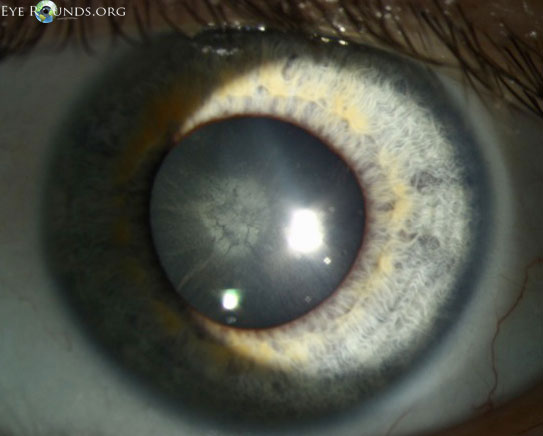 Ocular syphilis