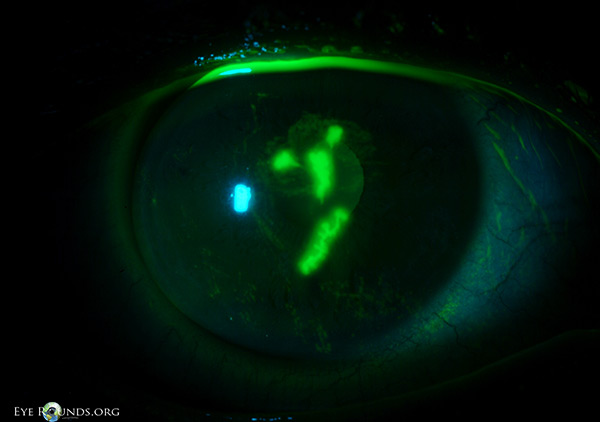 Slit lamp photo. classic epithelial dendrites after fluorescein staining