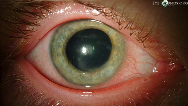 Classic immune stromal keratitis with mid-deep stromal infiltration and intact epithelium