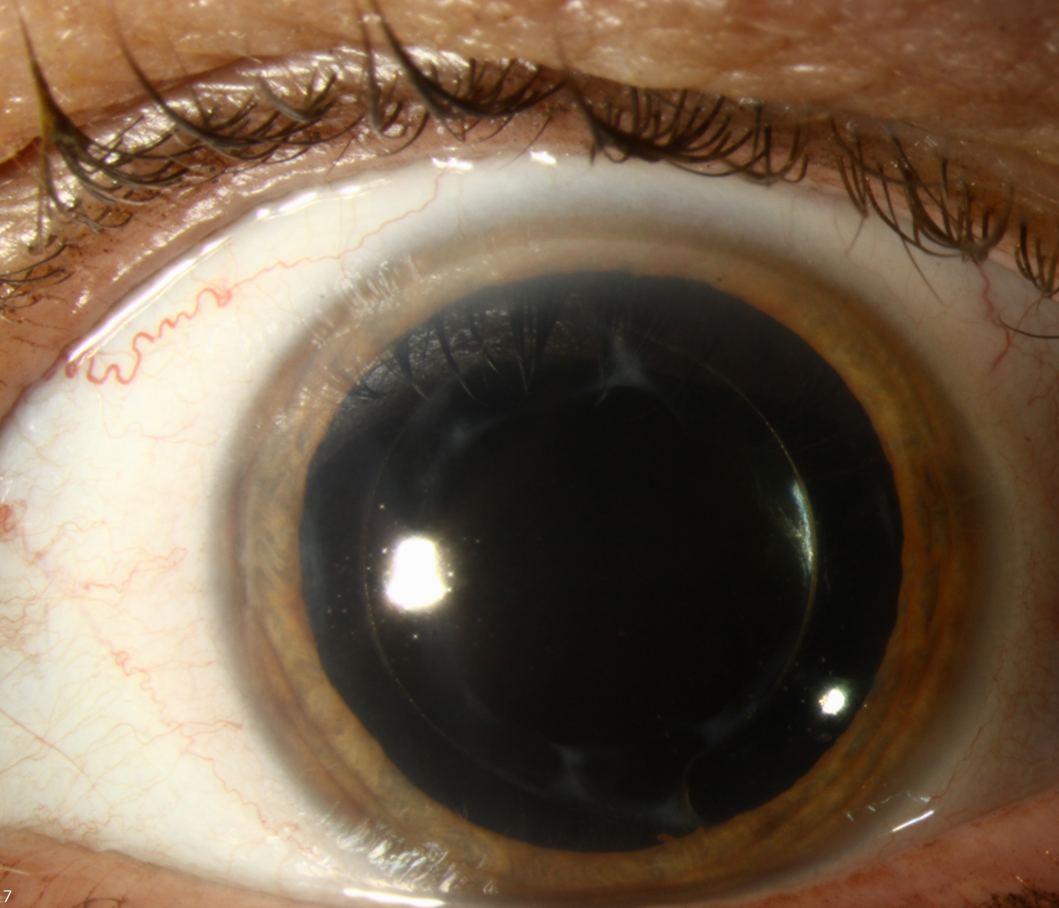 Toric Lens IOL exchange :: The University of Iowa, Ophthalmology