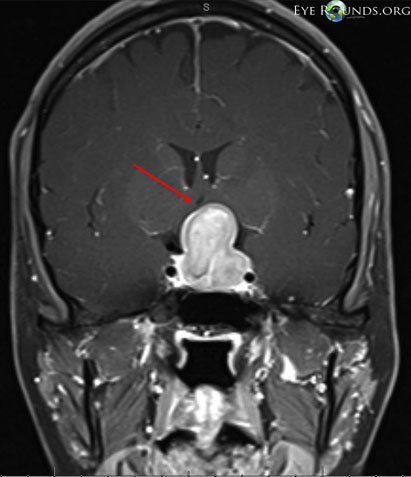 POst-contrast T1 brain MRI