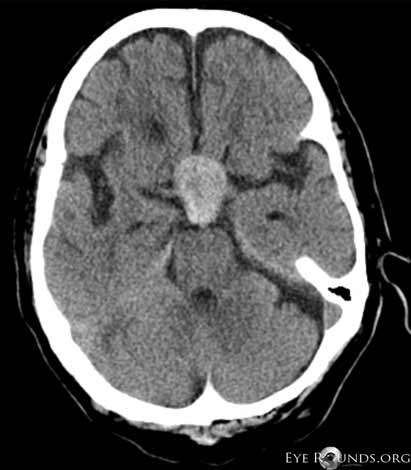 non-contrast head CT, axial view