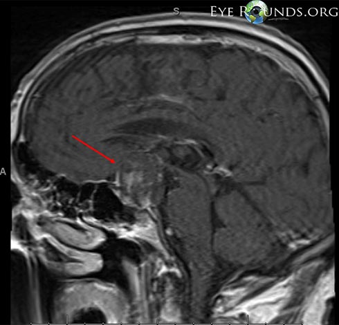 Post-constrast T1 brain MRI, mid-sagital view