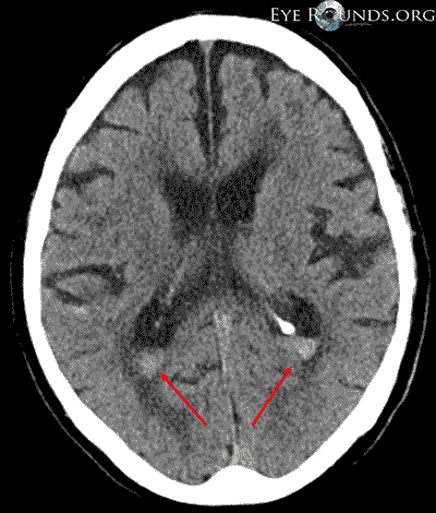 Non-contrast chead CT, axial view