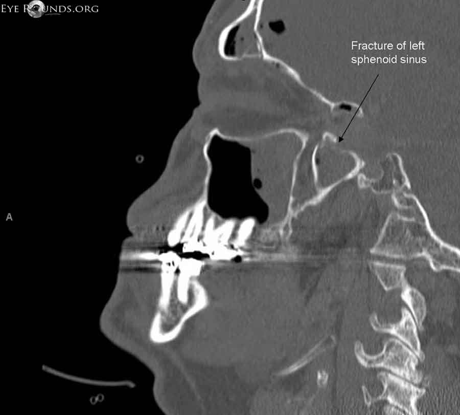 Sagittal computed tomography (CT) scan showing fracture of posterolateral aspect of left sphenoid sinus in area of left optic canal