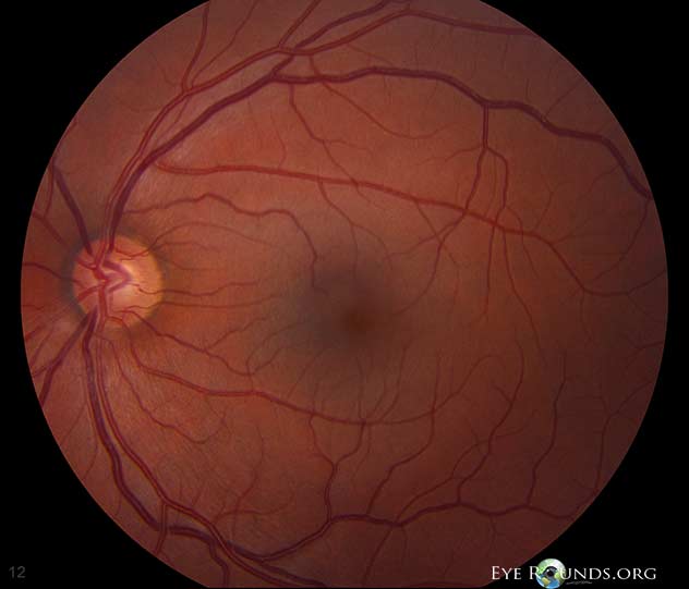Fundus photographs showing asymmetric optic nerve head cupping