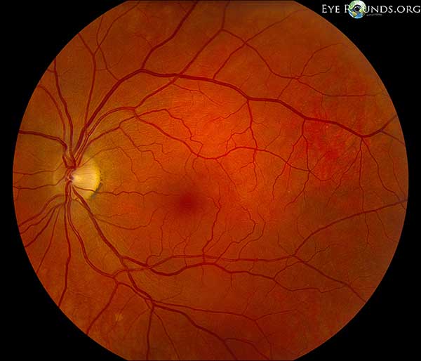 There are a few small hard drusen in the macula. The fundus is otherwise unremarkable.