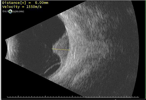 B-scan ultrasonography revealed an irregular, peaked choroidal mass 6 mm in height x 13 mm at its base