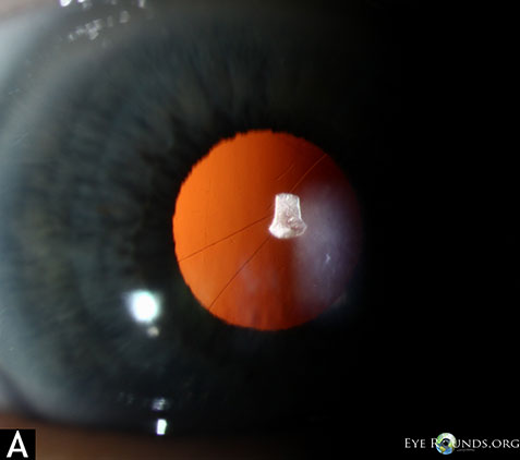 Posterior capsular folds following cataract surgery